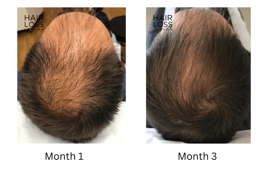 Topical Finasteride solution, DHT blocker that actually works ?