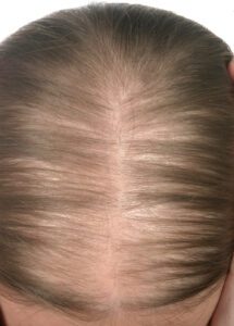 Female Pattern Hair Loss