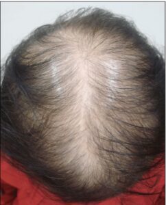 Female Pattern Hair loss