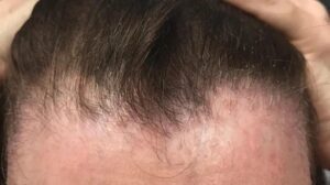 Frontal Fibrosing Alopecia