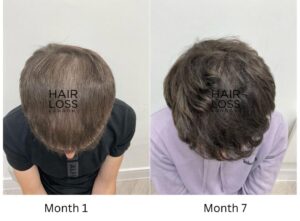 Male pattern hair loss
