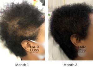 Traction Alopecia