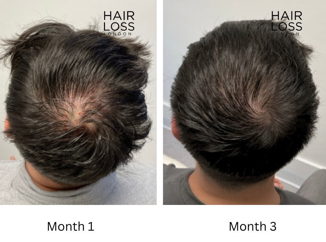 Hair transplant men
