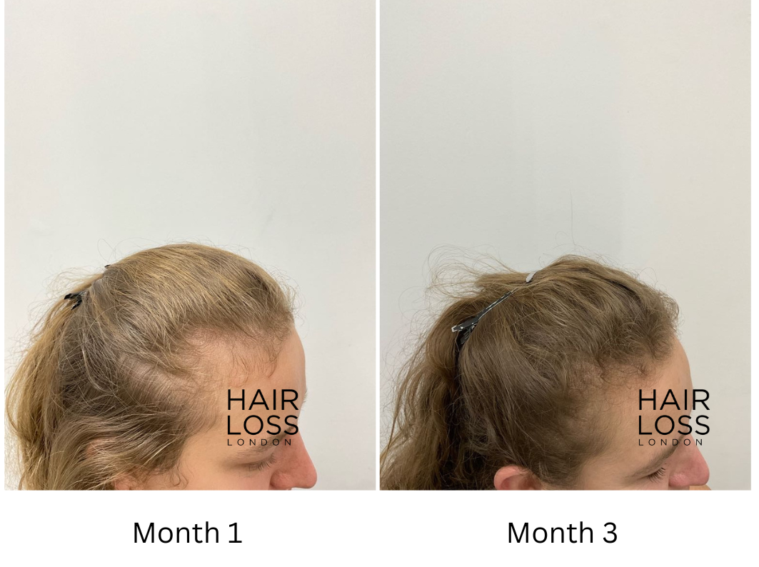 Platelets rich plasma for hair