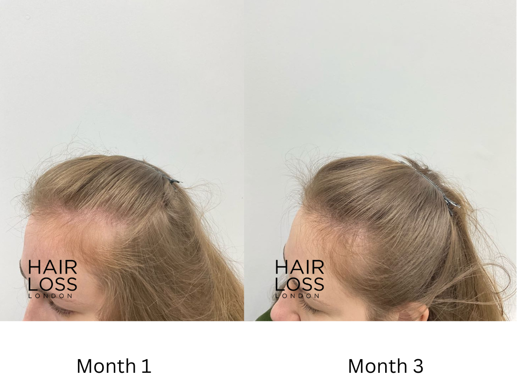 Plasma rich protein for hair