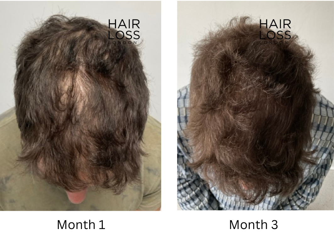 Platelets rich plasma PRP hair