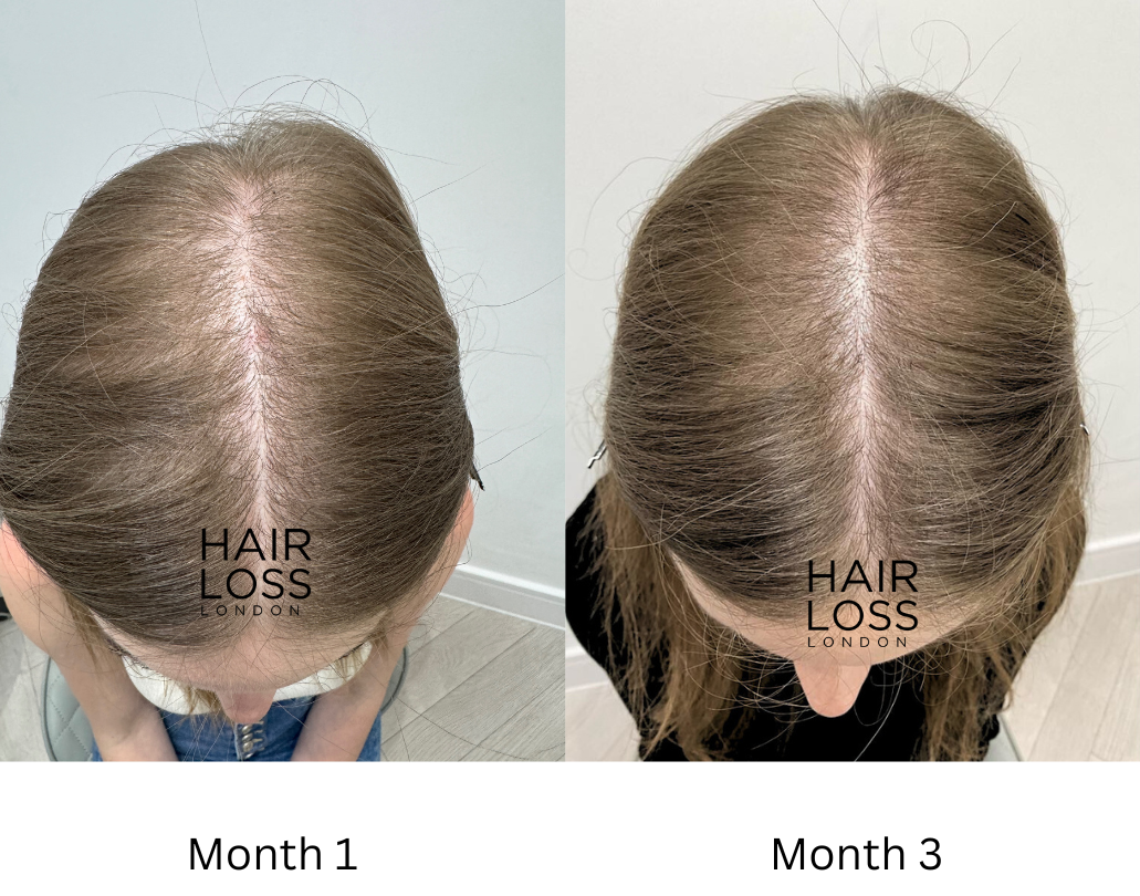 Androgenic Alopecia in women