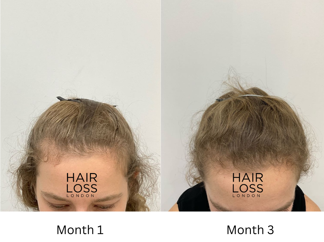 Women receding hairline