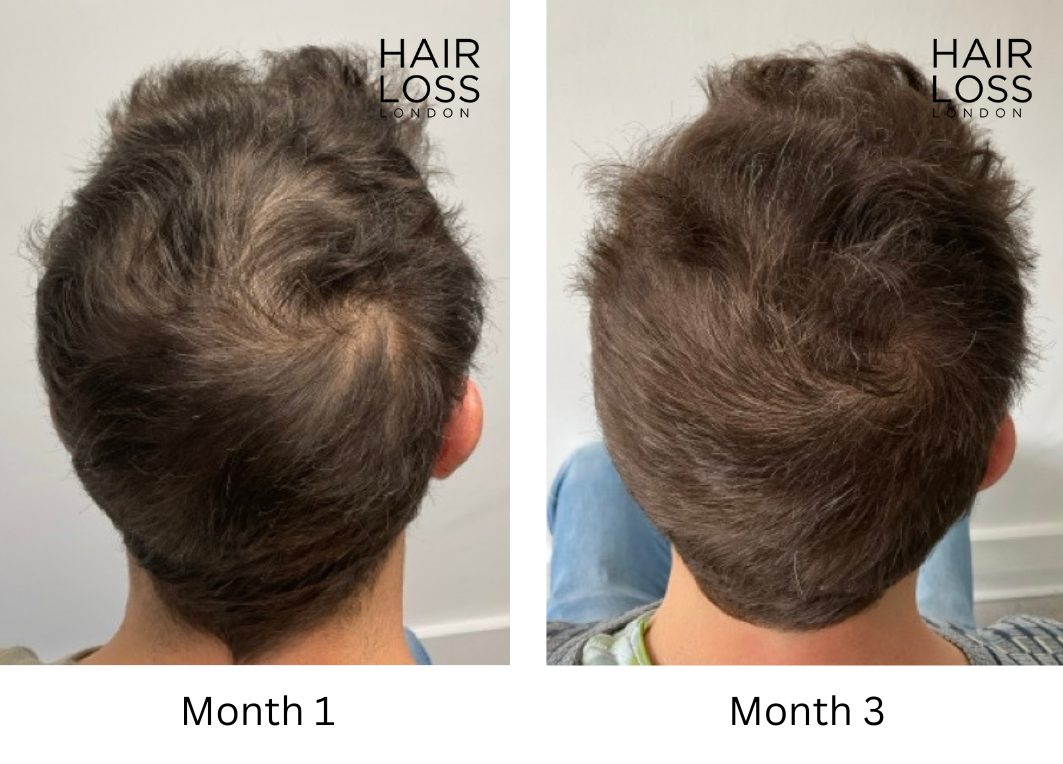 Platelet enriched plasma hair loss