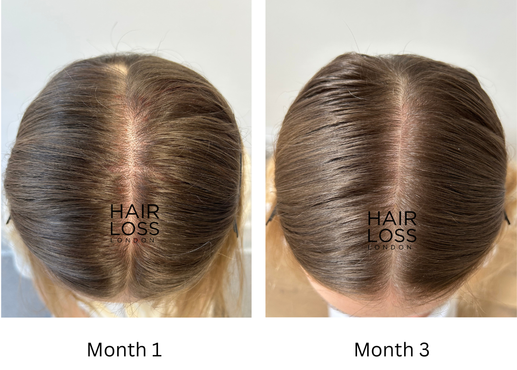 Hair transplant women