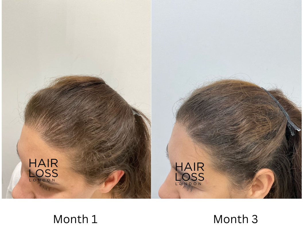 PRP and hair loss
