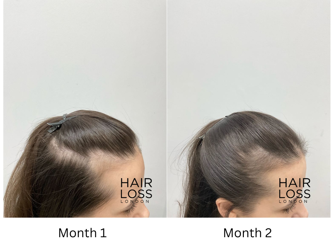 PRP for hair fall