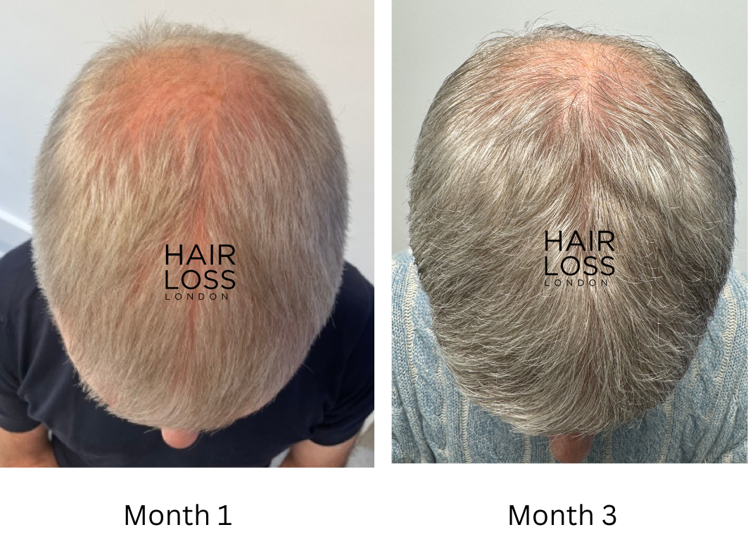 Grey hair on men