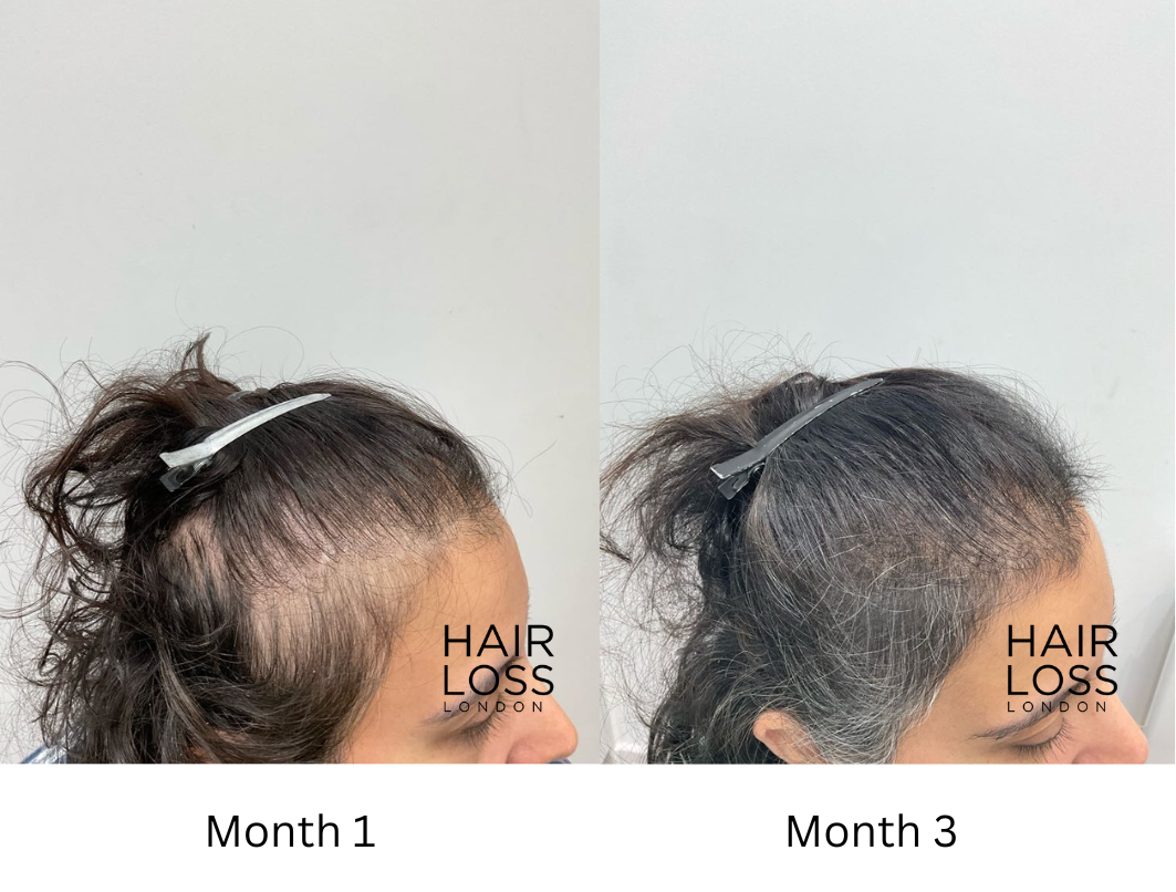 Androgenic alopecia treatment in women