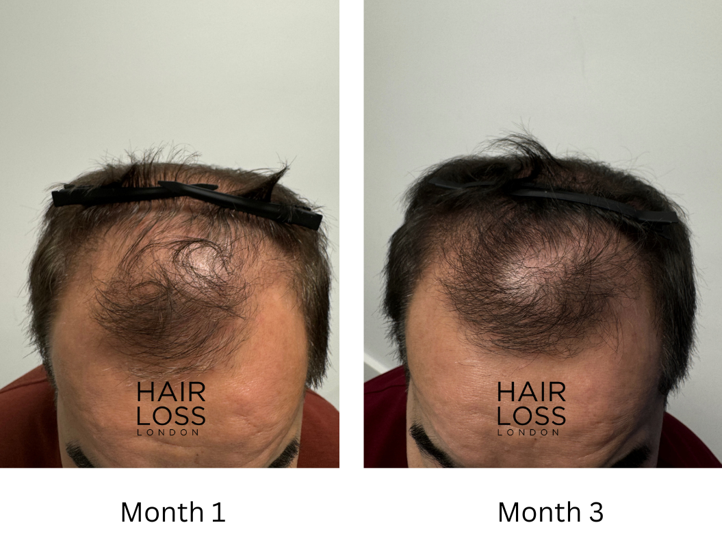 Dutasteride injections