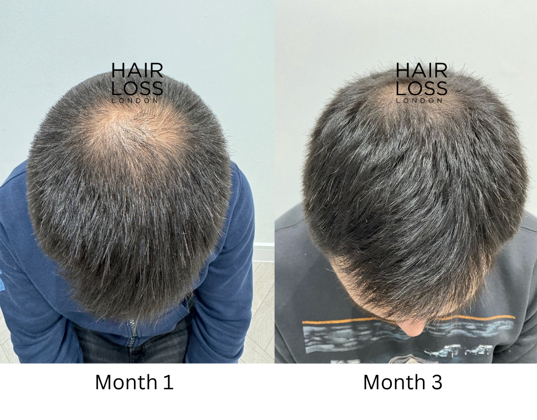 Finasteride solution