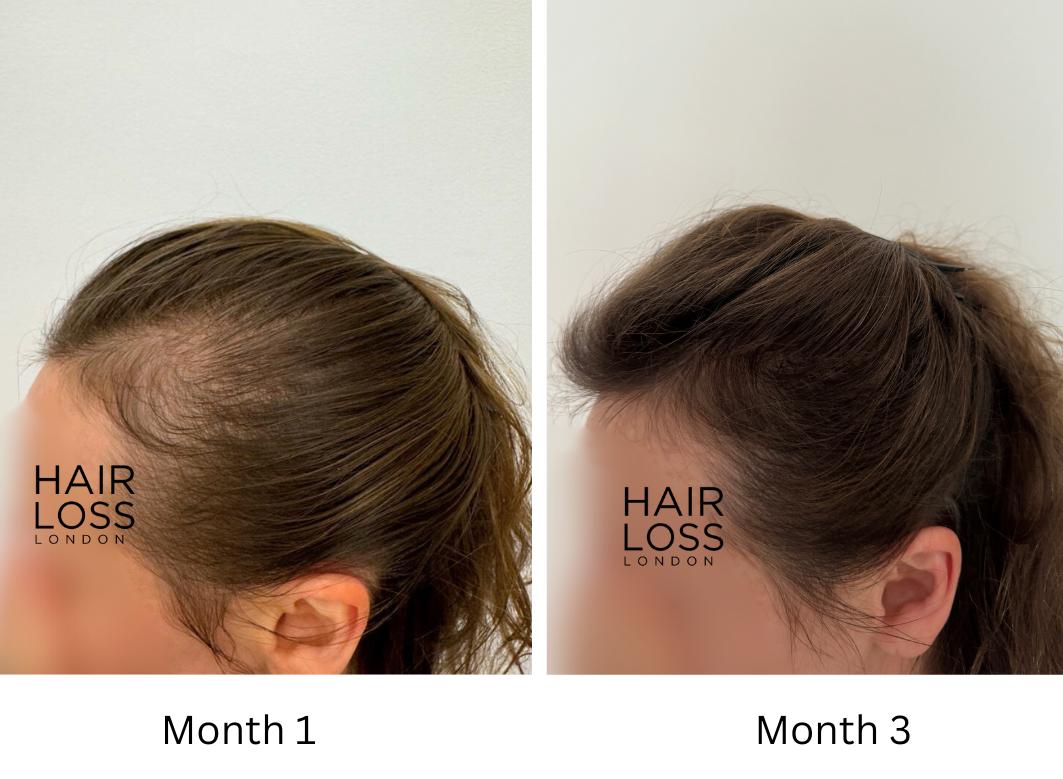 PRP treatment for balding