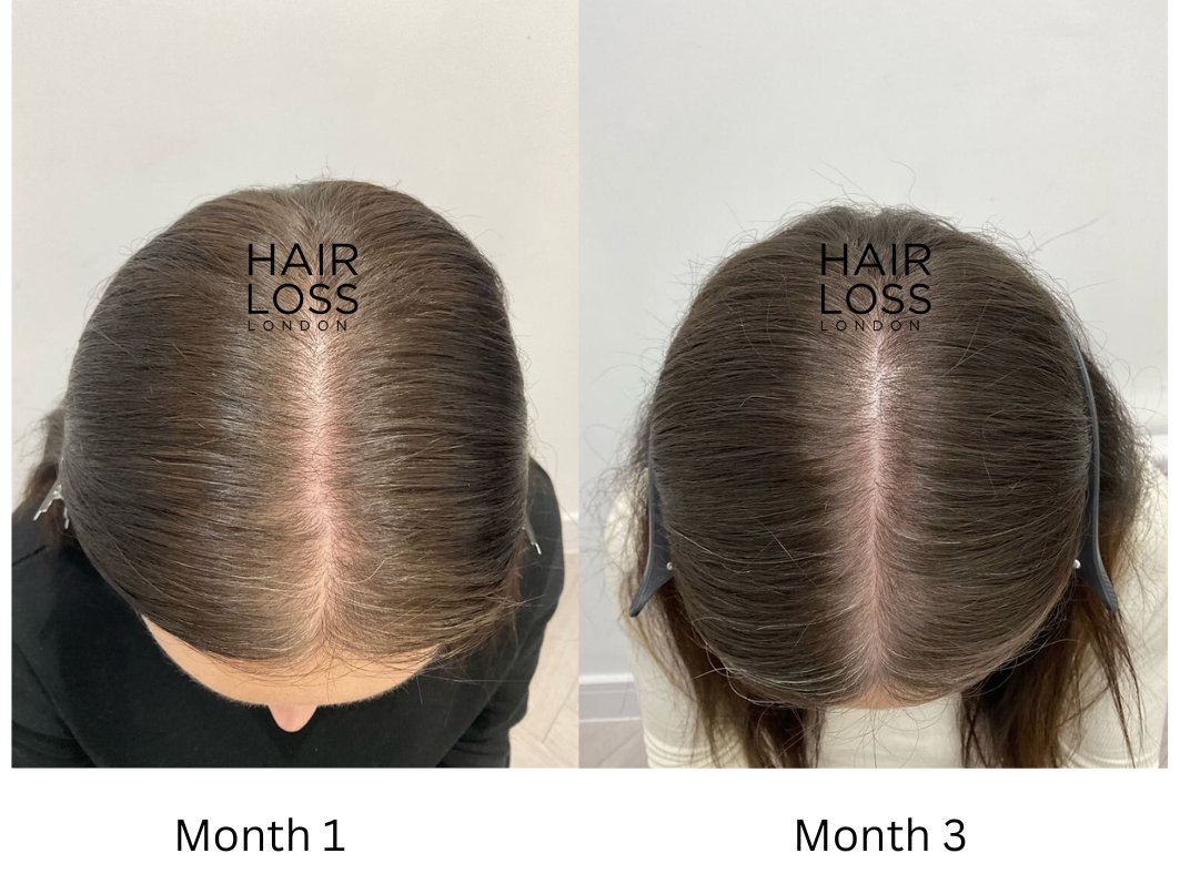 Rosemary oil for hair loss