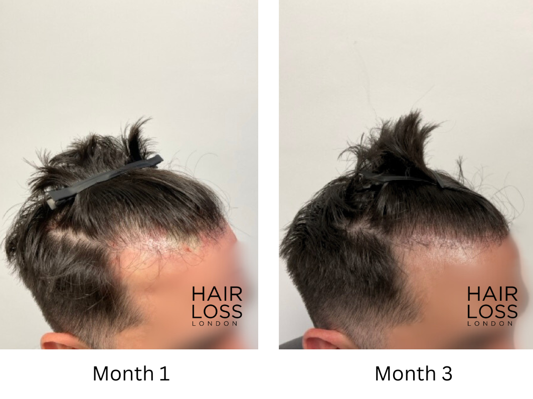 David Beckham balding