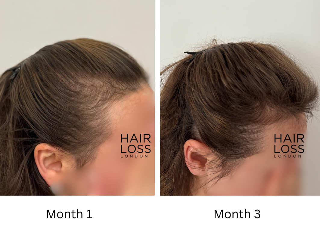 Female receding hairline