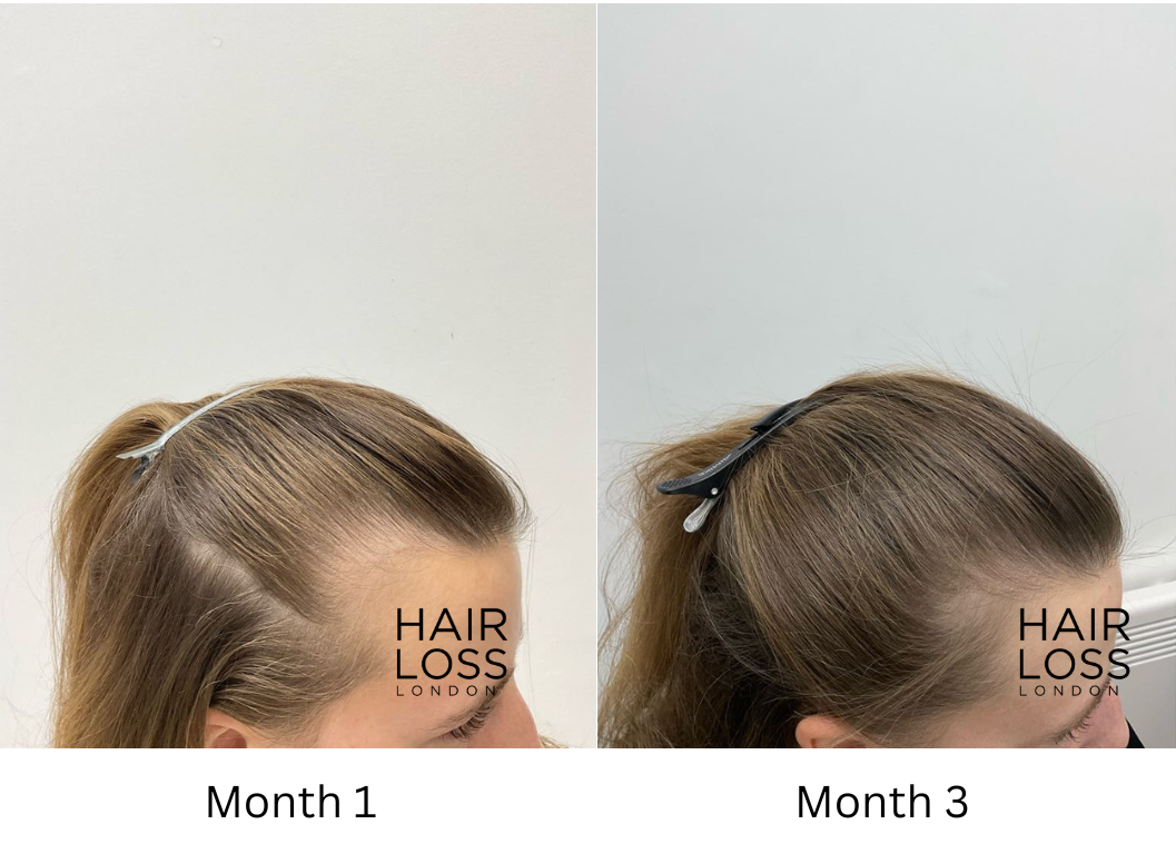 Frontal balding female