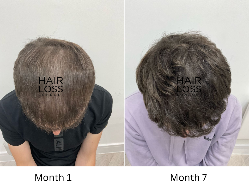 Hair growth solution