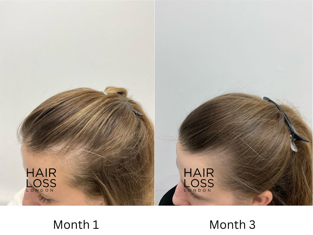 hair thinning women treatment
