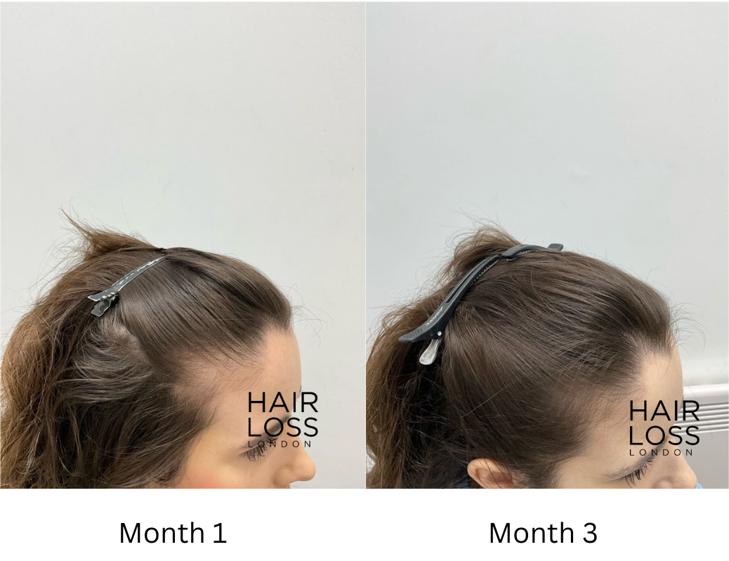 platelets rich plasma PRP for hair loss