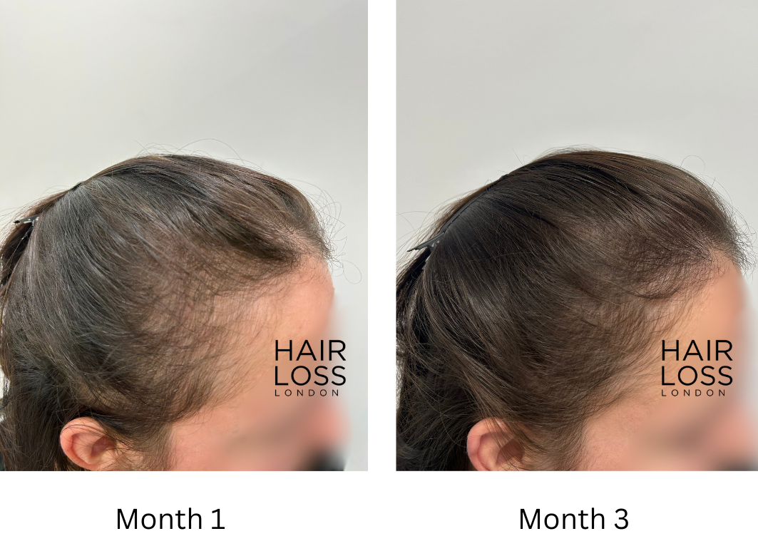 telogen effluium hair loss