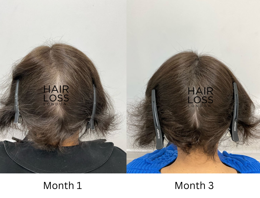 Telogen effluvium hair loss in women