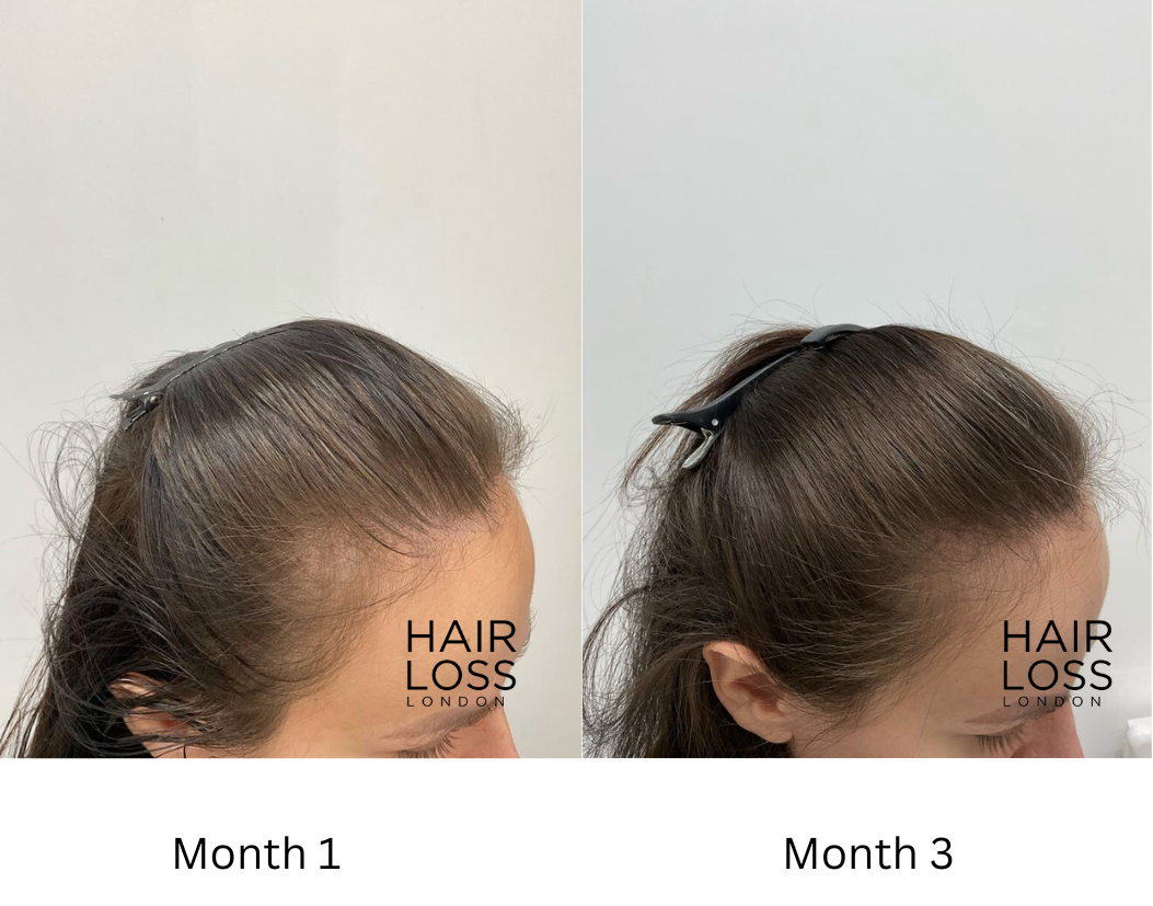 Treatment for hair thinning in women