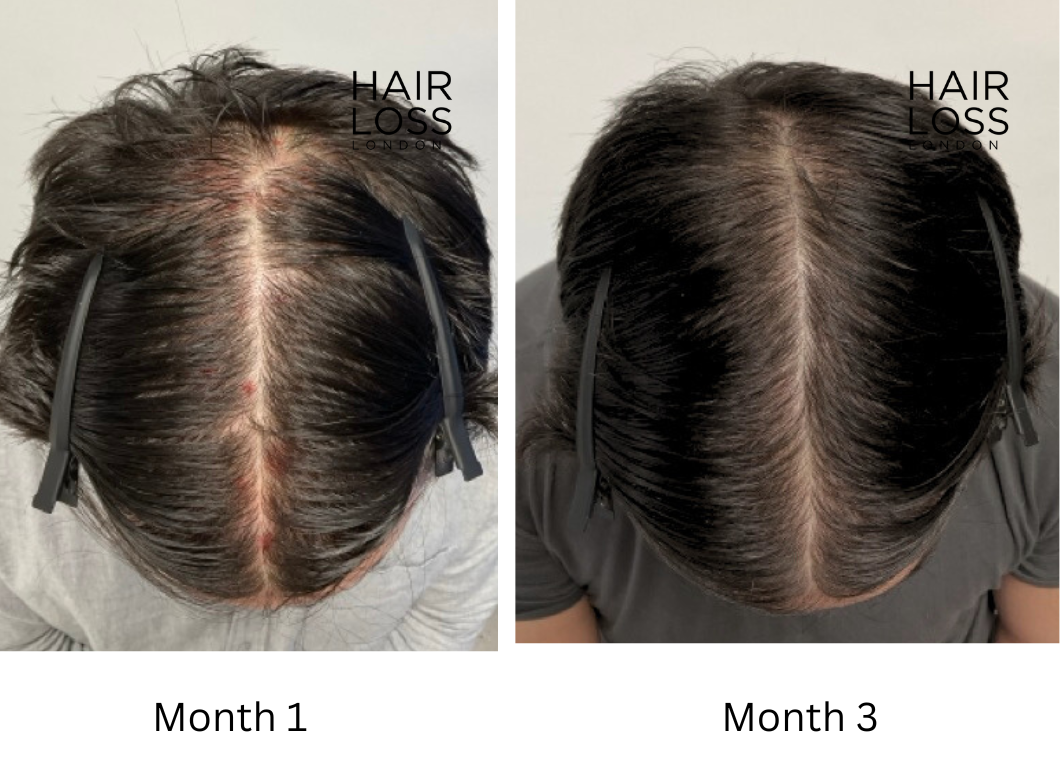 Wayne Rooneys hair transplant