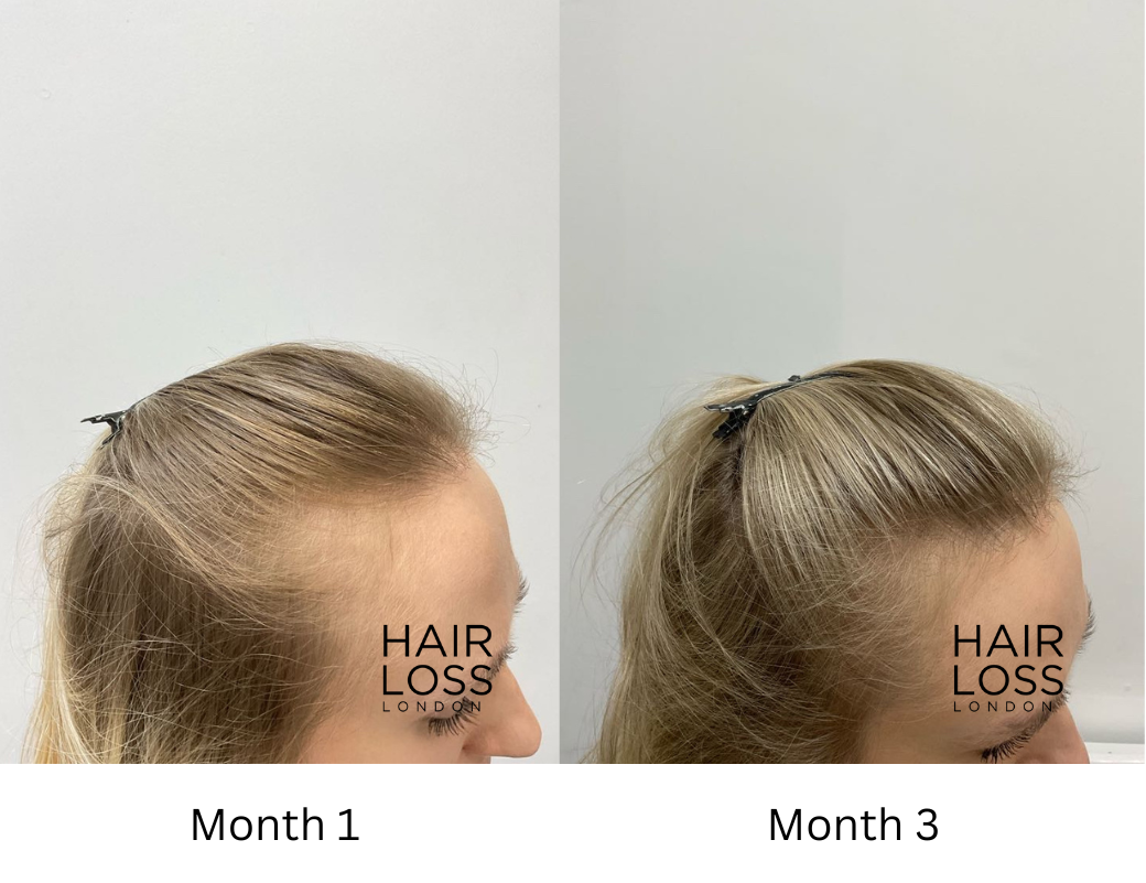 Women receiding hairline