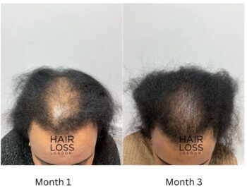 Folliboost Hair Growth